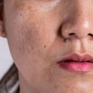 Peaux grasses à imperfections : action purifiante et équilibrante