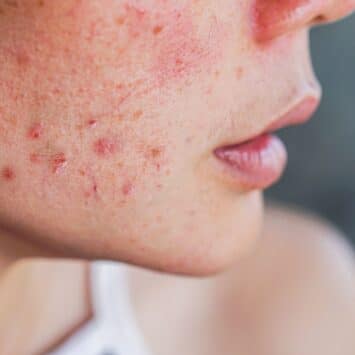 Points noirs, boutons rouges, kystes : comment les distinguer