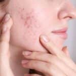 Acné hormonale