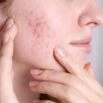 Acné hormonale