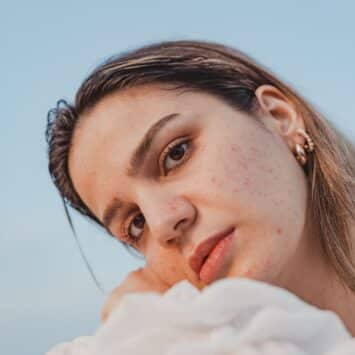 Causes principales de l'acné hormonale