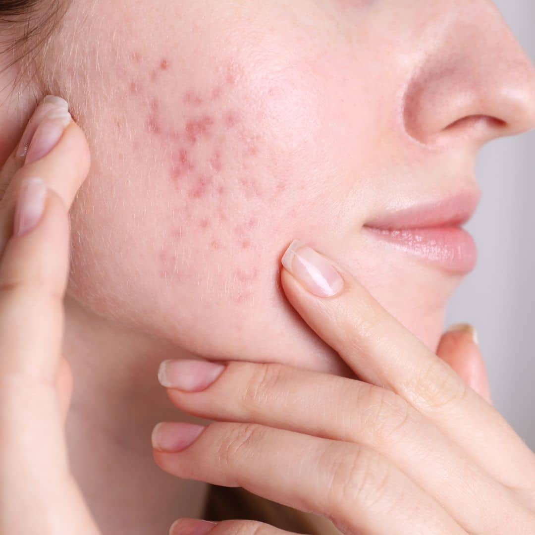 Acné hormonale